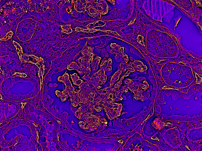 OI-DIC image of immunohistochemistry for complement C4d component in kidney allograft.