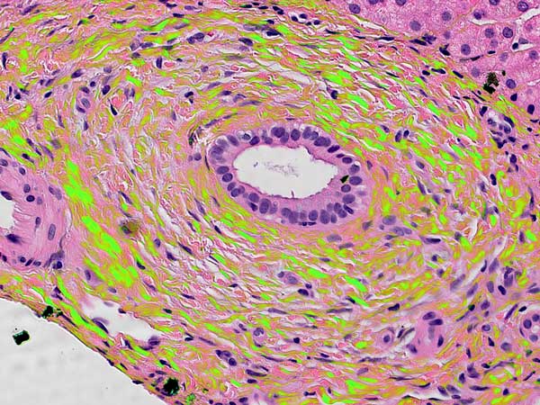 Polarization polychromatic image of birefringent collagen fibers in H&E-stained liver cancer tissue. Credit: Michael Shribak and Richard Levenson