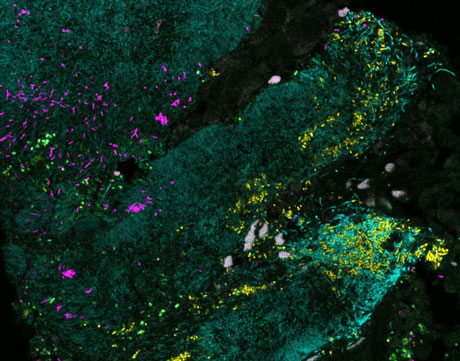 Bacteria forming a mixed biofilm on colon cancer tissue. Credit: Jessica Mark Welch, Blair Rossetti, and Christine Dejea