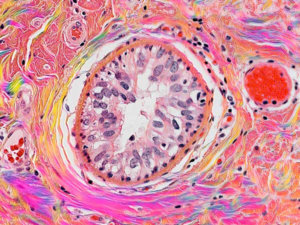 Polarization polychromatic image of birefringent collagen fibers in H&E-stained breast cancer tissue. Credit: Michael Shribak and Richard Levenson