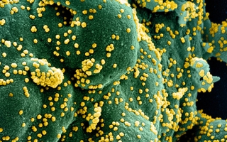 Colorized scanning electron micrograph of an apoptotic cell (green) heavily infected with COVID-19 virus particles (yellow), isolated from a patient sample. Image captured at the NIAID Integrated Research Facility (IRF) in Fort Detrick, Maryland. Credit: NIAID